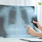 肺癌標靶出現抗藥性！破解迷思才能看見治療新方向