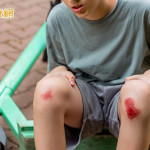 傷口癒合不是結束　預防疤痕從「這時機」開始！醫揭疤痕凝膠應用策略