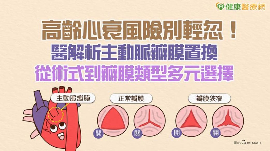 高齡心衰風險別輕忽！醫解析主動脈瓣膜置換　從術式到瓣膜類型多元選擇