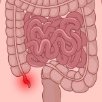 急性阑尾炎轻忽不得