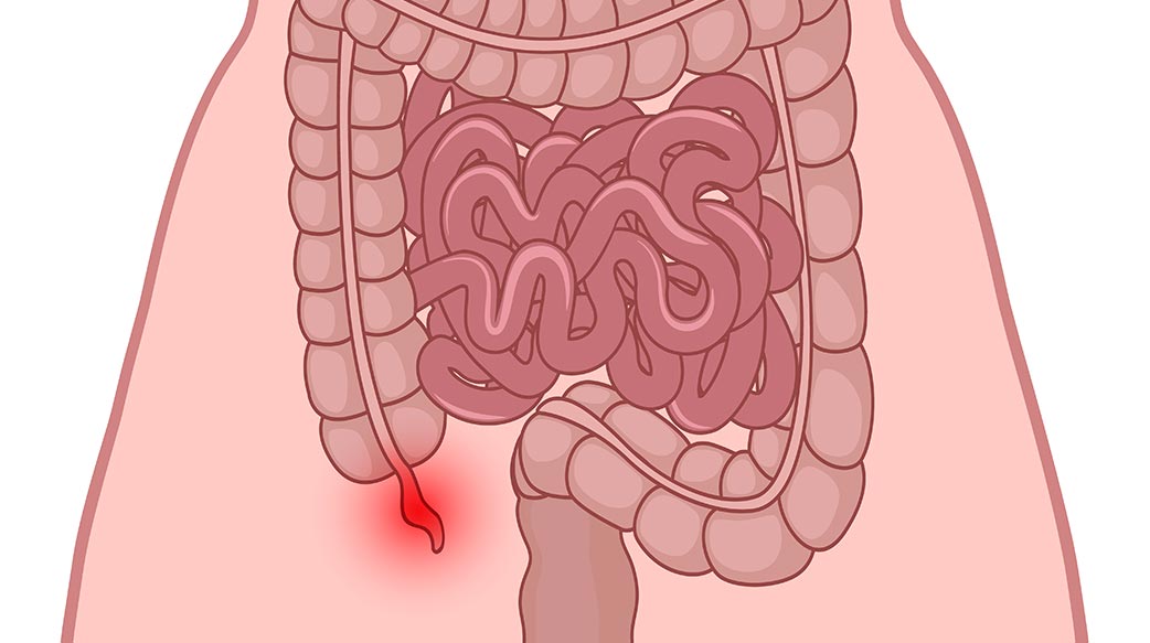 急性阑尾炎轻忽不得