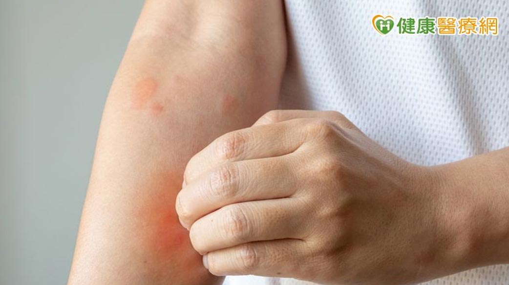 乾癢脫屑反覆發作　可能不只是氣候乾燥！中醫談常見類型與日常保養