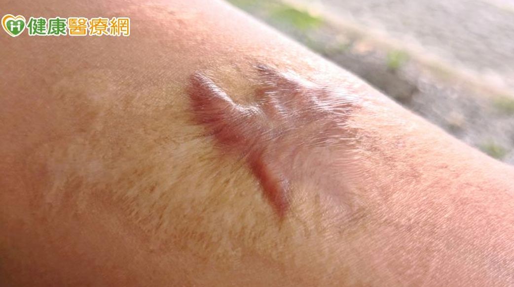 每天睡不到兩小時！中年女罹「蟹足腫」困擾30年　跨科聯手救回她的睡眠